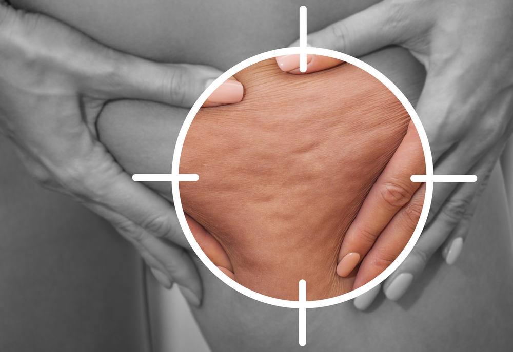 Cellulite gladstrijken op de benen